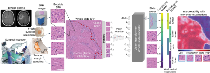 Foundation models for fast, label-free detection of glioma infiltration post thumbnail image